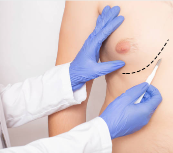  عملية علاج التثدي عند الرجال