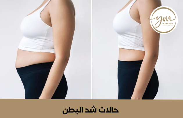 اسعار عملية شد البطن