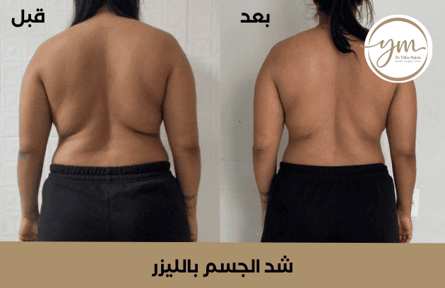 تجربتي مع شد الجسم بالليزر