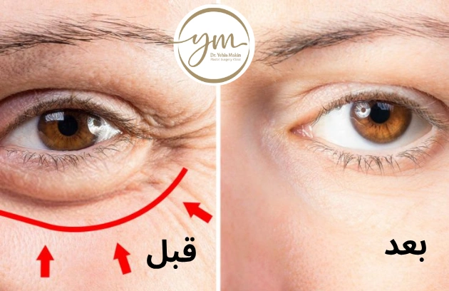 تجربتي مع عملية شد الجفون في مصر