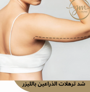 شد ترهلات الذراعين بالليزر