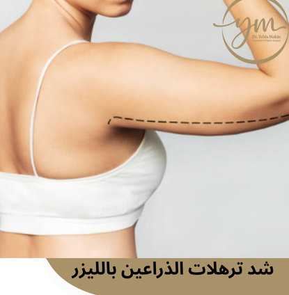شد ترهلات الذراعين بالليزر