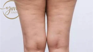 علاج الوذمة الشحمية lipedema