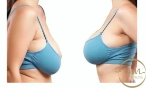 سعر عملية تصغير الثدي