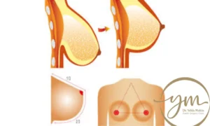 عمليات شد الثدي قبل وبعد