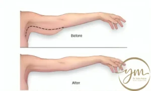 عملية شد الذراعين من الباط