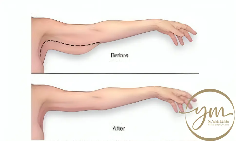 عملية شد الذراعين من الباط