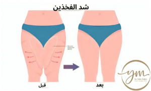 عملية شد الفخذين بالصور