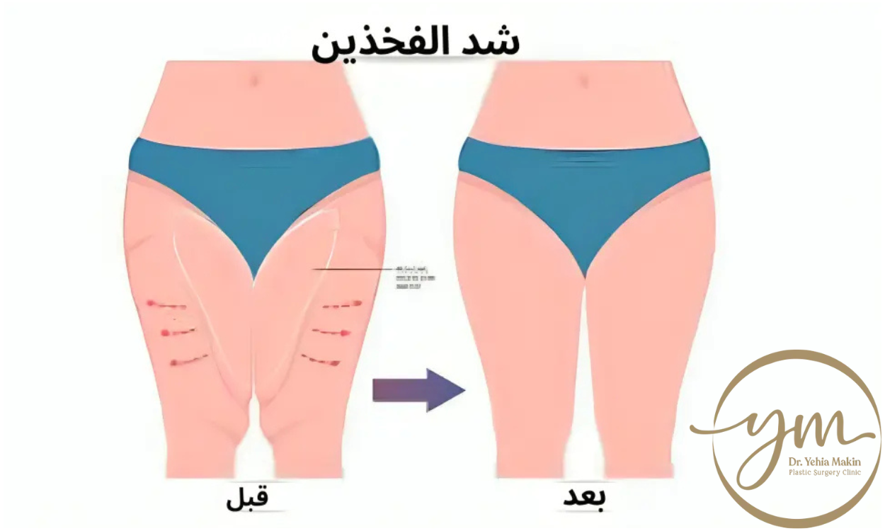 عملية شد الفخذين بالصور