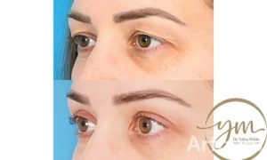 تجربتي مع عملية شد الجفون في مصر