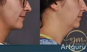 تكلفة عملية إزالة اللغد في مصر