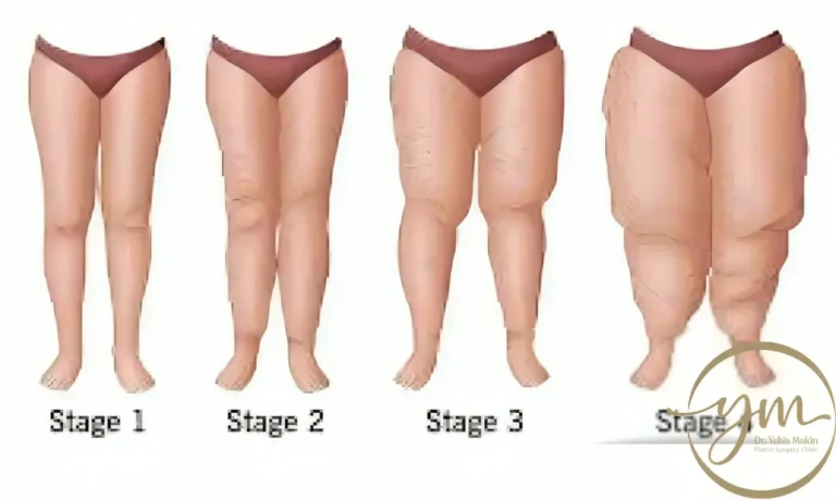 علاج الوذمة الشحمية بالاعشاب