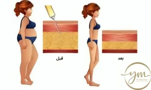 هل عملية شفط الدهون خطيرة