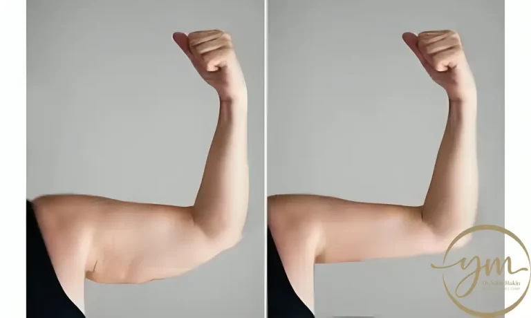 تجربتي مع شفط دهون الذراعين Arm Liposuction
