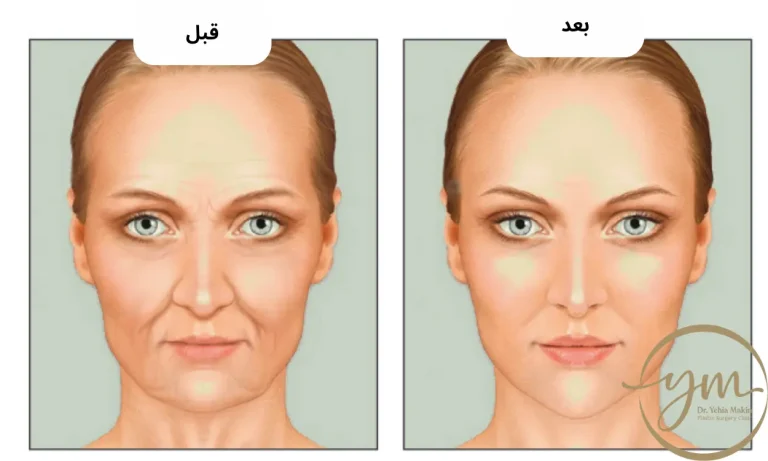 حقن الدهون الذاتية في الوجه