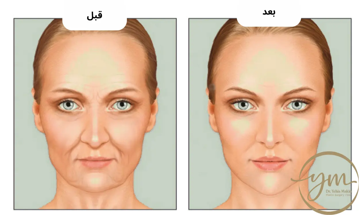 حقن الدهون الذاتية في الوجه