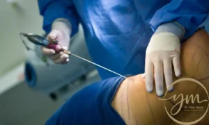 تجربتي مع شفط الدهون بالفيزر