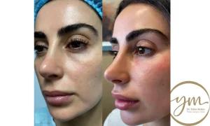 علاج تجويف تحت العين