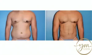 عملية شد ترهلات البطن للرجال