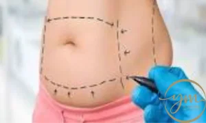 هل عملية شد البطن مؤلمة