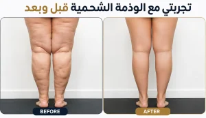 تجربتي مع الوذمة الشحمية قبل و بعد