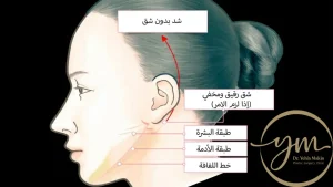 شد الوجه بدون جراحة - التقنيات الحديثة والمميزات مع د. يحيي مكين