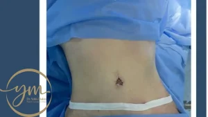 عملية Tummy Tuck شد البطن في مصر - د. يحيي مكين