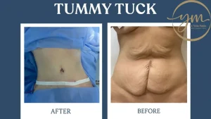 عملية Tummy Tuck شد البطن في مصر - د. يحيي مكين
