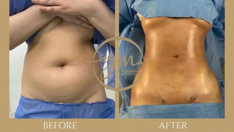 ما الفرق بين شفط الدهون Liposuction وعملية نحت الجسم Liposculpture؟ - د. يحيي مكين