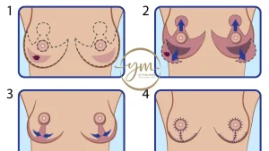 هل تؤثر عملية Breast Reduction على الرضاعة الطبيعية مستقبلاً؟  - د. يحيي مكين