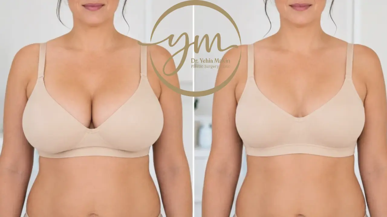 هل تؤثر عملية Breast Reduction على الرضاعة الطبيعية مستقبلاً؟ - د. يحيي مكين